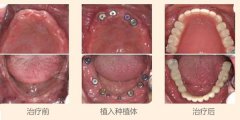 全口种植牙需要多少钱