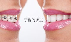牙齿不齐矫正要不要拔牙呢