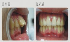 什么时候矫治暴牙比较合适呢