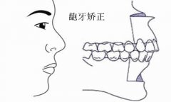 龅牙的矫正治疗的价格是多少钱