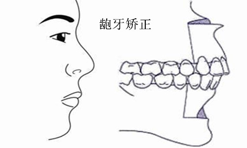 龅牙矫正