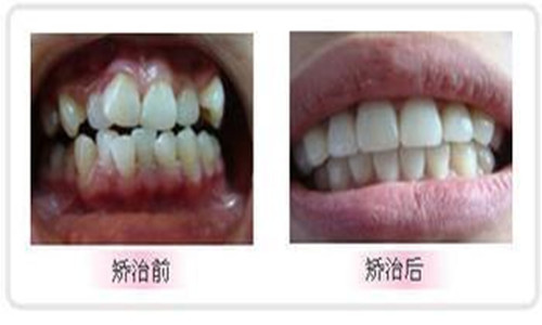 虎牙矫正