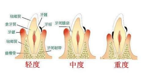牙周炎出现时的症状
