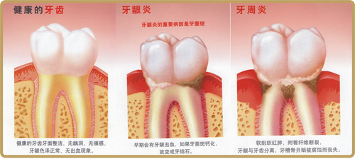 牙周炎出现时的症状