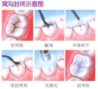 窝沟封闭的过程中会疼吗
