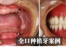 选择全口种植牙修复牙需要满足哪些条件？