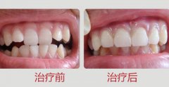 牙列不齐是否可以预防?