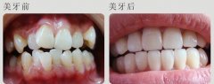 牙列不齐是健康的“隐形炸弹