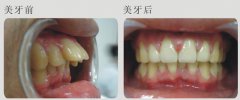 成人龅牙矫正最好的方法是什么?