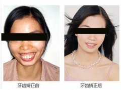 龅牙矫正需要多长时间呢?
