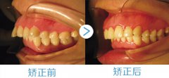 龅牙形成的原因是什么？