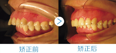 龅牙形成的原因是什么？