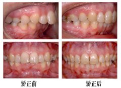 专家解析龅牙的症状表现