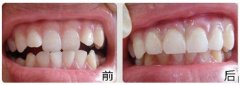 成年人牙齿拥挤有什么方法矫正？
