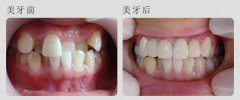 牙齿拥挤矫正是否需要拔牙吗？