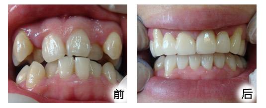 虎牙矫正前后对比图