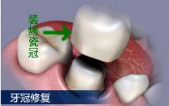 哪些情况下需要做牙冠修复