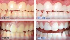 轻度四环素牙用什么美白方法好