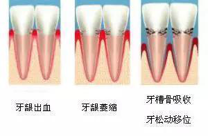 刷牙出血了怎么办？