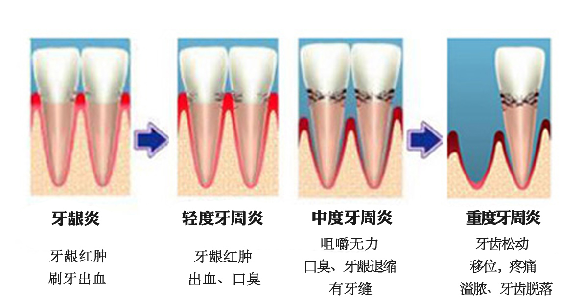 牙周病