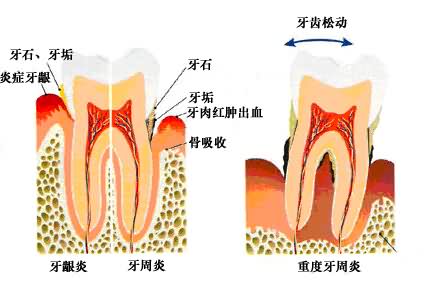 牙周病