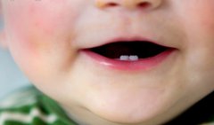 孩子的乳牙坏了到底需不需要治疗呢