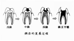 小孩蛀牙怎么办