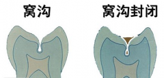 窝沟封闭后要注意哪些事项