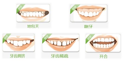 常见的牙齿畸形示意图