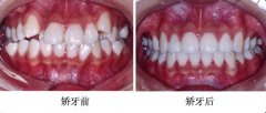 虎牙的危害及矫正方法
