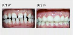 老鼠牙怎么办呢