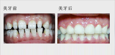 老鼠牙