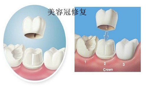 美牙冠修复