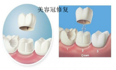 为什么选择用美容冠修复牙齿呢