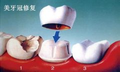 做美牙冠寿命能维持多久