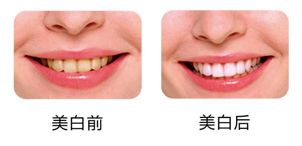 氟斑牙美白