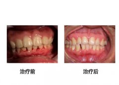 牙龈出血什么原因导致的