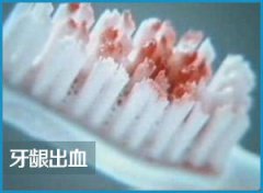 福州牙龈出血要怎么治疗