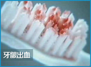 张家港牙龈出血要怎么治疗
