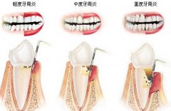 怎样判断自己是不是患了牙周炎