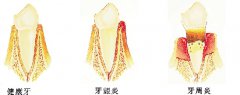 牙周病是什么原因导致的