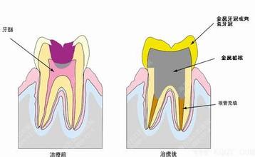 牙髓炎的治疗