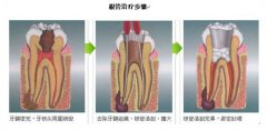 牙髓炎做根管治疗好不好