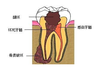 得了牙髓病应注意哪些?