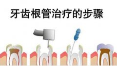 根管治疗有什么特点呢
