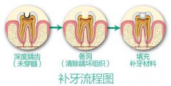 龋齿补牙一般需要几次能完成呢