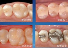 蛀牙补牙常用的材料有哪些?哪种的好?