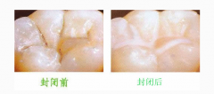 窝沟封闭有什么用