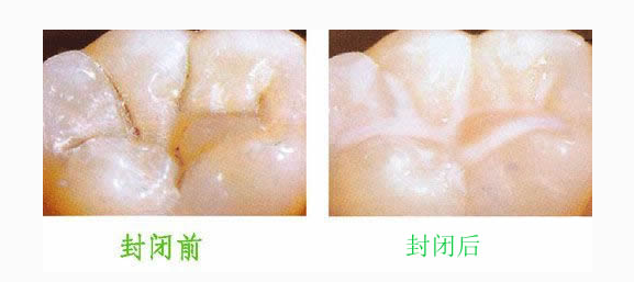 窝沟封闭对比图