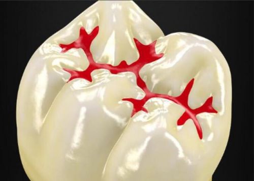 张家港做窝沟封闭可以预防龋齿吗